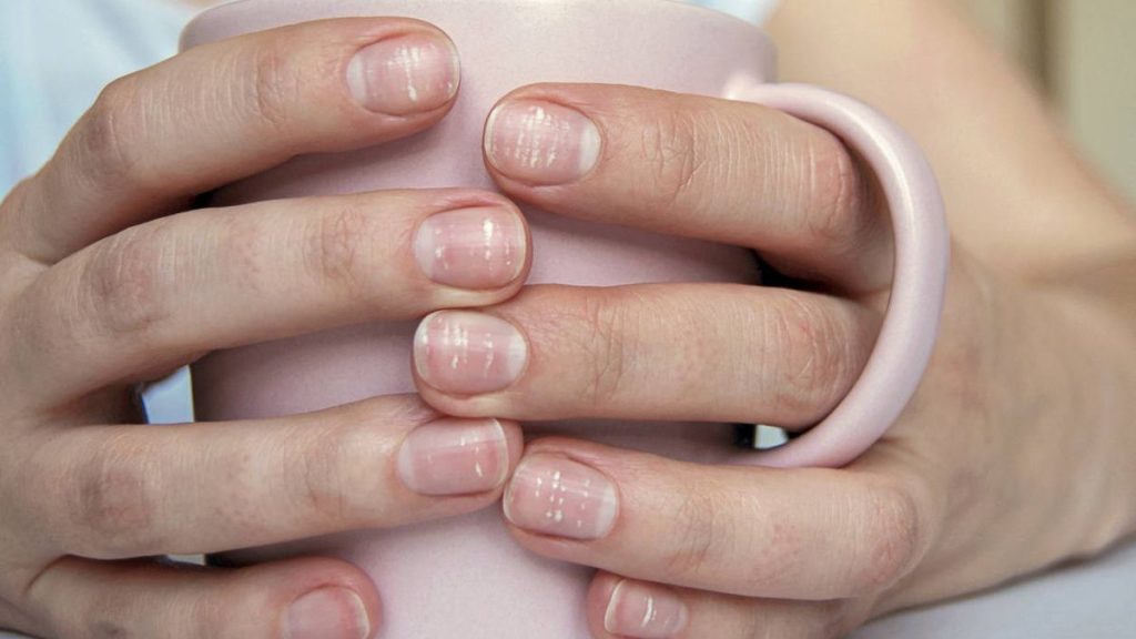 Enfermedades y problemas de las uñas: Cómo prevenir y tratar afecciones comunes